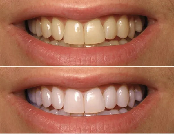 Blanqueador dental profesional lapiz